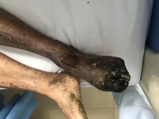 糖尿病足的冬季护理