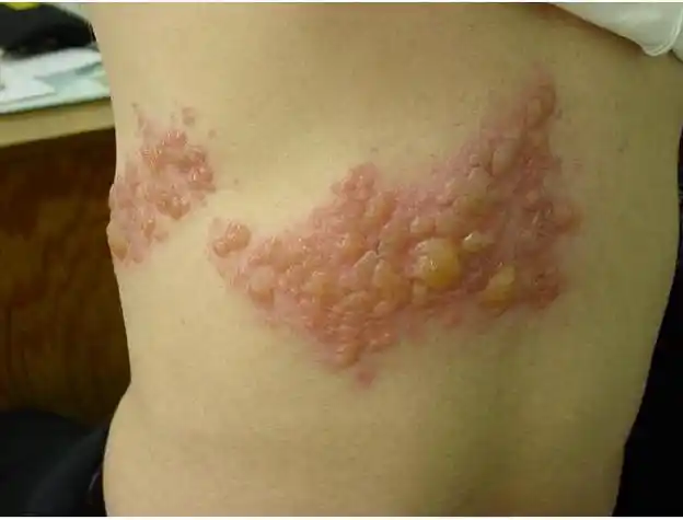 蛇盘疮图片 (41)