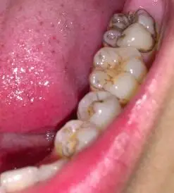 我的牙齿内侧发黑怎么办我不抽烟喝酒的,对不起恶心大家了.