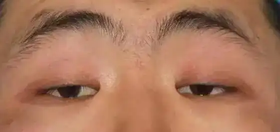 自测:你的眼睑下垂了吗?【昆明华美美莱】