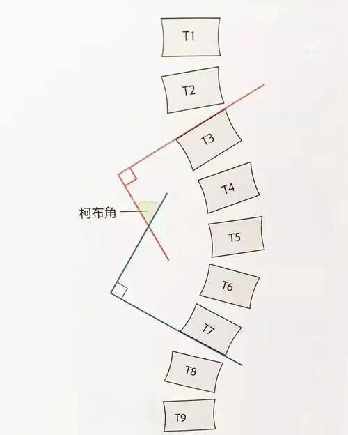 严重脊柱侧凸是指冠状面上cobb角≥90°,常合并较严重的后凸畸形,明显