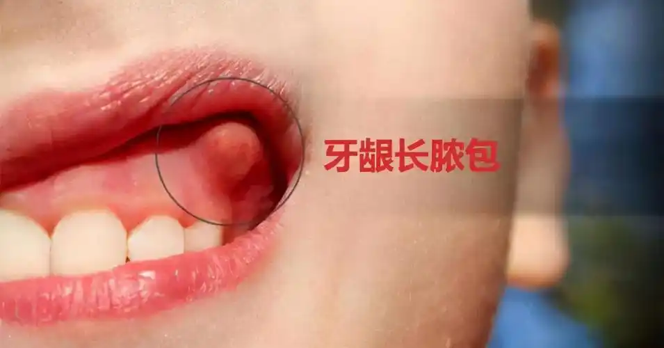 在牙龈里面刺激牙龈,平时刷牙又无法去除,因此会经常发生牙龈发炎肿痛