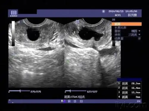 射精管囊肿? - 超声医学讨论版 - 爱爱医医学论坛 - 爱爱医医学网