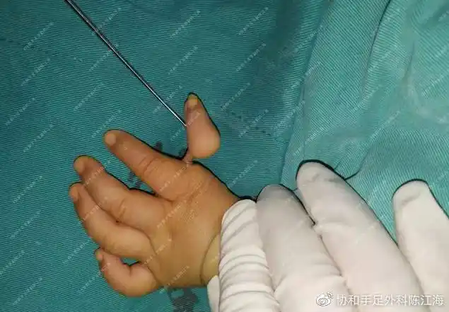 怀胎十月,10次产检都正常,宝宝出生却手指畸形,谁来"买单"-爱子网