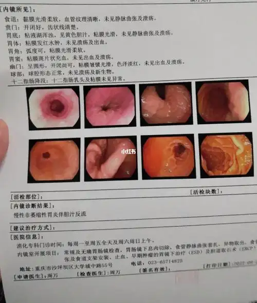 慢性非萎缩性胃炎伴胆汁反流