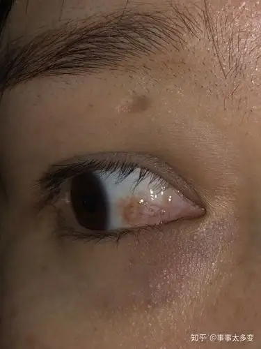 眼结膜色素痣治疗记录