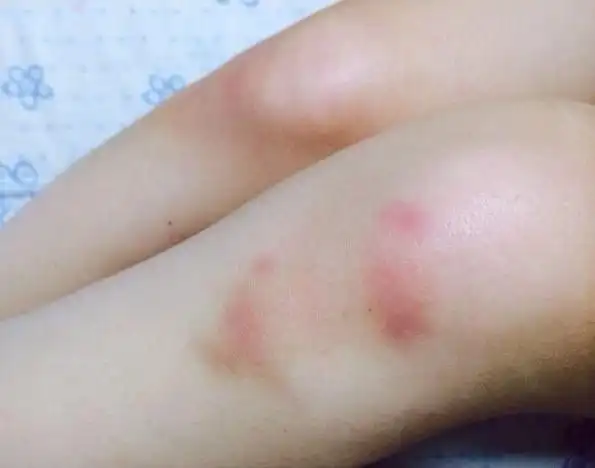 【夏颖翀】按摩,腿淤青,在日中国留学生的打工日常