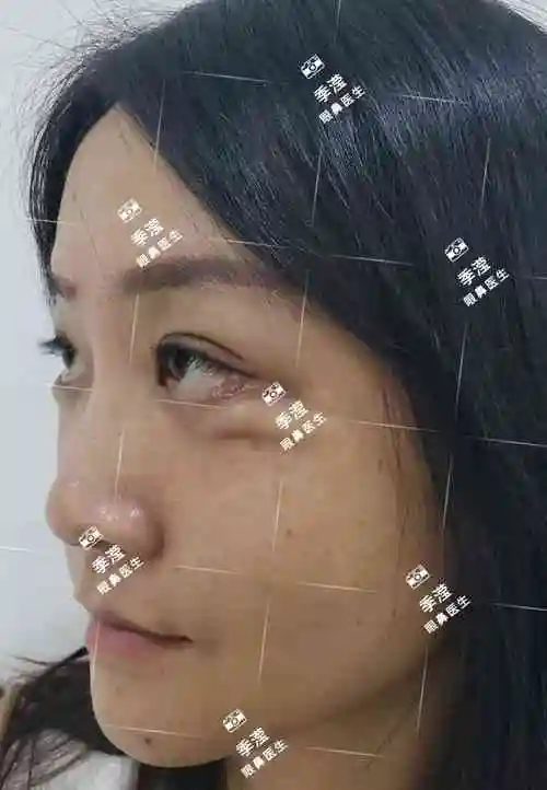 下眼睑外翻,退缩修复,同时内轮廓提升案例模特(有肖像权)_眼睑外翻