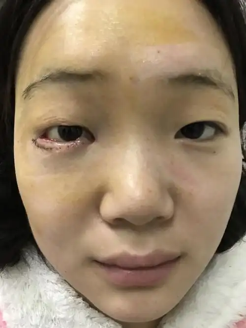 睑裂闭合打开后,下睑内翻睑裂闭合时