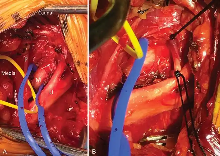 thieme e-journals - journal of brachial plexus and peripheral