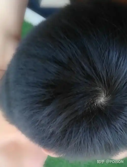 请问我这个发旋和发际线正常吗平时11点左右睡觉头发透光变黄色每次