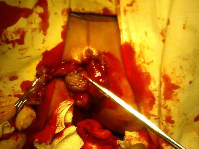 外痔切除齿线上粘膜芍倍图片