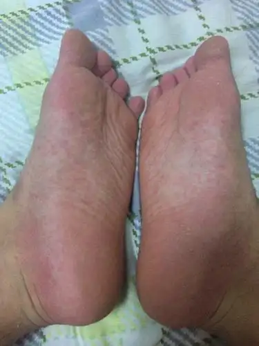 汗疱疹多出现于手掌与足底处,表现为表皮深处的黄豆大小圆形水疱,水疱