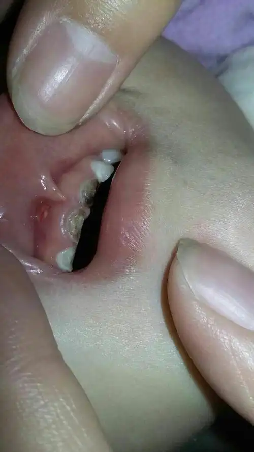 两岁宝宝门牙的牙龈上长脓包?