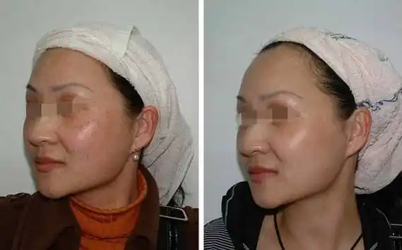 液氮祛斑为什么皮肤会反黑_百科-8s新商盟