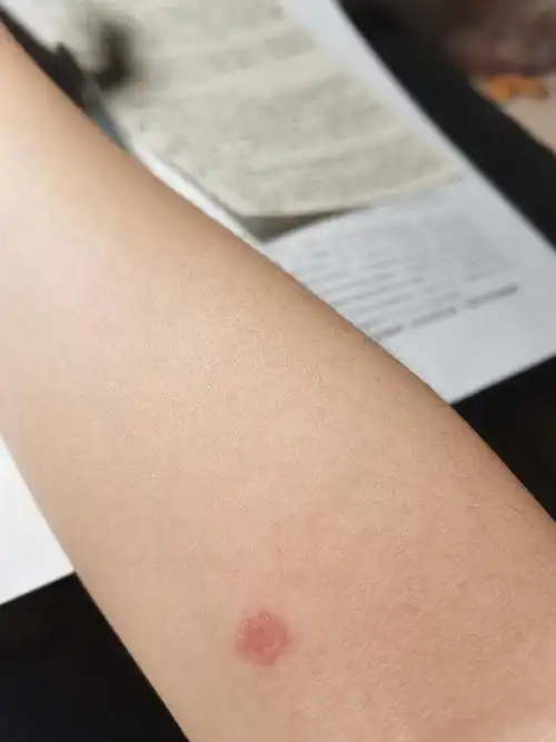 养猫后身上长藓,不止一个,这是什么啊,我有给它驱虫什么的