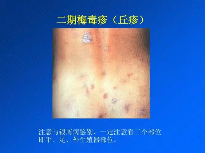 性传播疾病stdppt_word文档在线阅读与下载_无忧文档