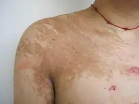 贝克痣怎么治疗