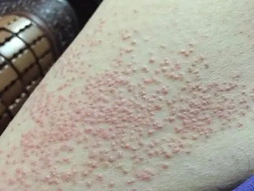 孕妇疥疮初期皮肤症状图片