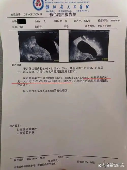 复查卵巢囊肿消失啦!