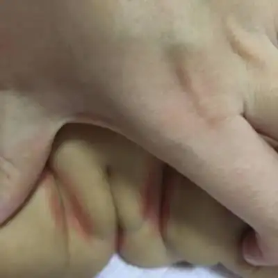 宝宝三个月,很严重的尿布疹,各位宝妈有啥好方法吗?