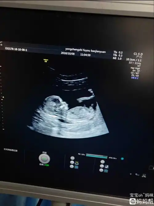 金灿灿!nt检查值看男女的方法介绍"注意事项"-第2张图片-天福博客