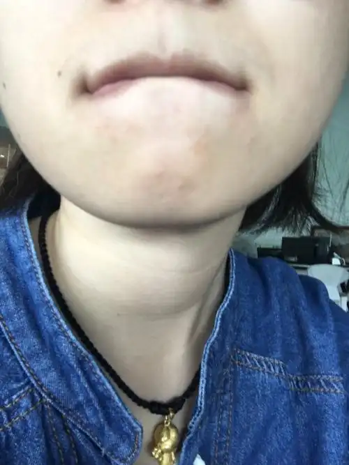 下巴这里长小红疹,上面还有白色米粒一样的点点是怎么回事?