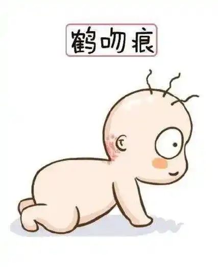 鹳吻痕常见于颈背部,额头,眼皮等部位,基本分布在身体的中线附近.