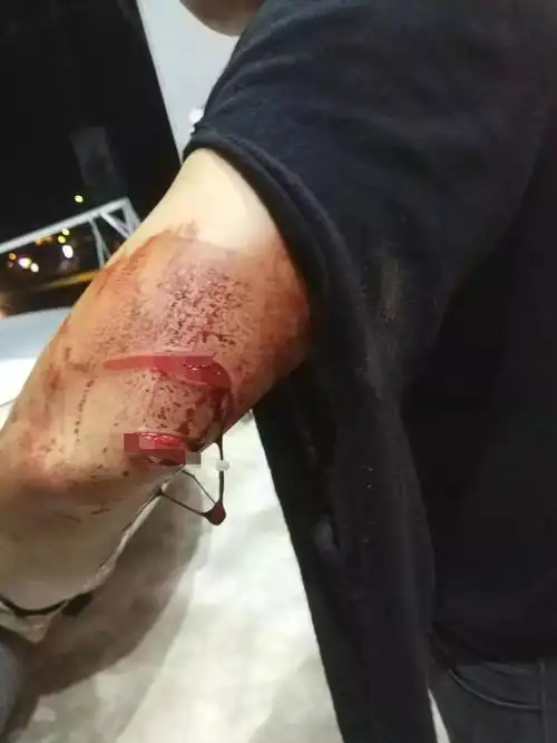 财务纠纷谈不扰中国男子遭合伙人砍伤