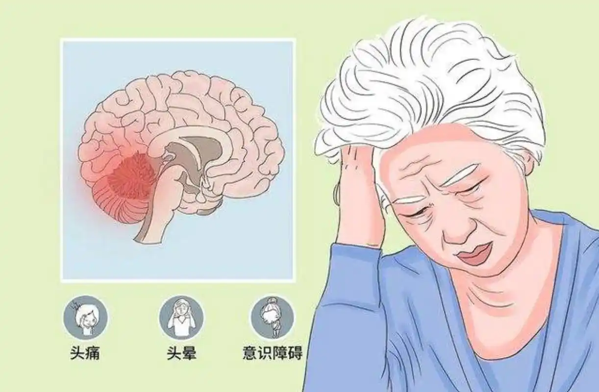 迷路震荡,常与脑震荡同时存在,迷路各部可有轻重不等的出血