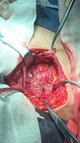 成功为阑尾切口疝修补术后复发施行二次修补手术