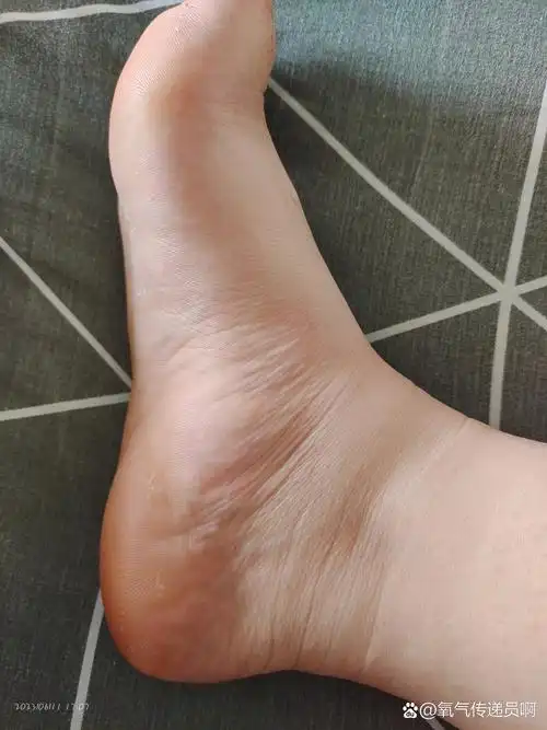 脚上这个鼓起来的包,是肿了吗?