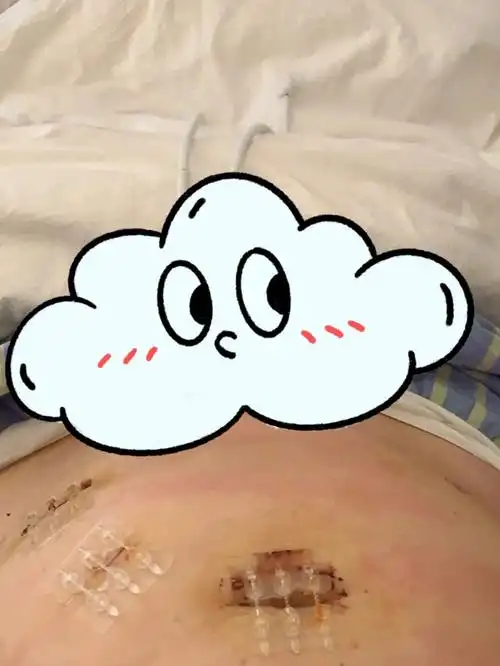 终于把纱布拆了,肚子上好像96四个伤口,曾经觉得自己的肚脐眼完美