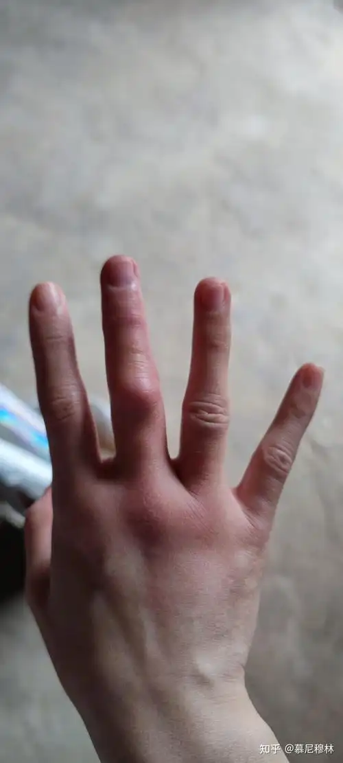 被小蚊子叮一口之肿了一只手