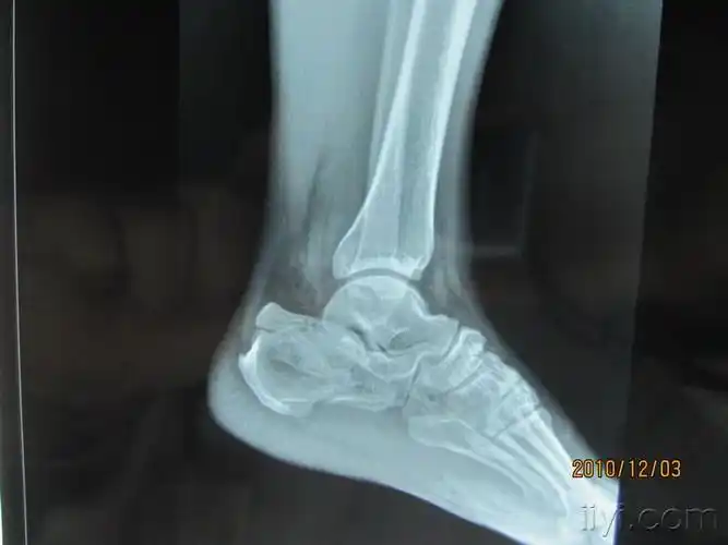左跟骨粉碎性骨折请教手术方案