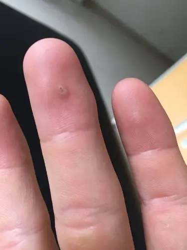 请问我这手上长得是刺猴吗?现在暂时没发现不痒不痛.该怎么办?