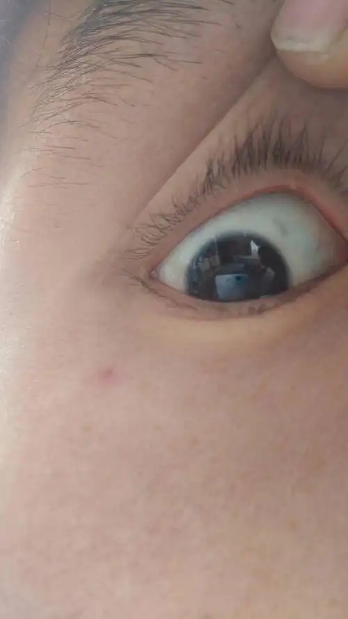 眼皮里面长了一个小痘痘,有点不舒服,请问用什么药可以治疗,求医生