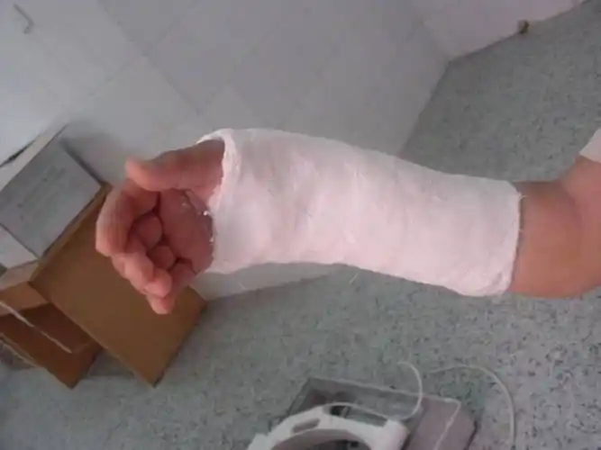 推荐| 四肢骨折后石膏外固定详解 - 好医术早读文章 - 好医术-赋能