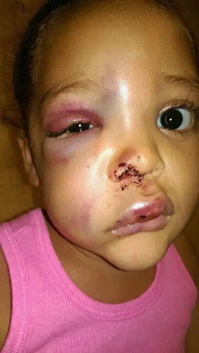 5岁女孩上学上到鼻青脸肿! 校方解释:她自己跌倒!