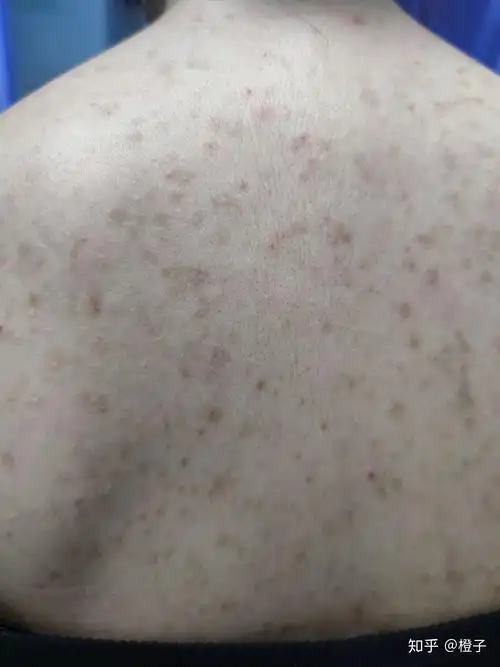 对背部痘印的作用效果还是很弱的,结痂的地方掉了还是会留下色素沉着
