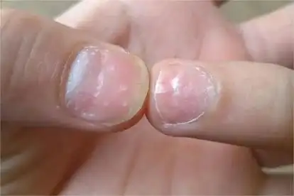 舟状指甲主要表现为指甲凹陷,呈舟状,可能是甲营养不良,甲癣等原因