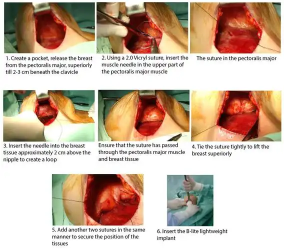 scarless mastopexy with lightweight breast implants
