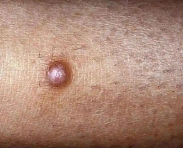 uptodate皮肤纤维瘤是真皮的成纤维细胞增殖导致的良性肿瘤