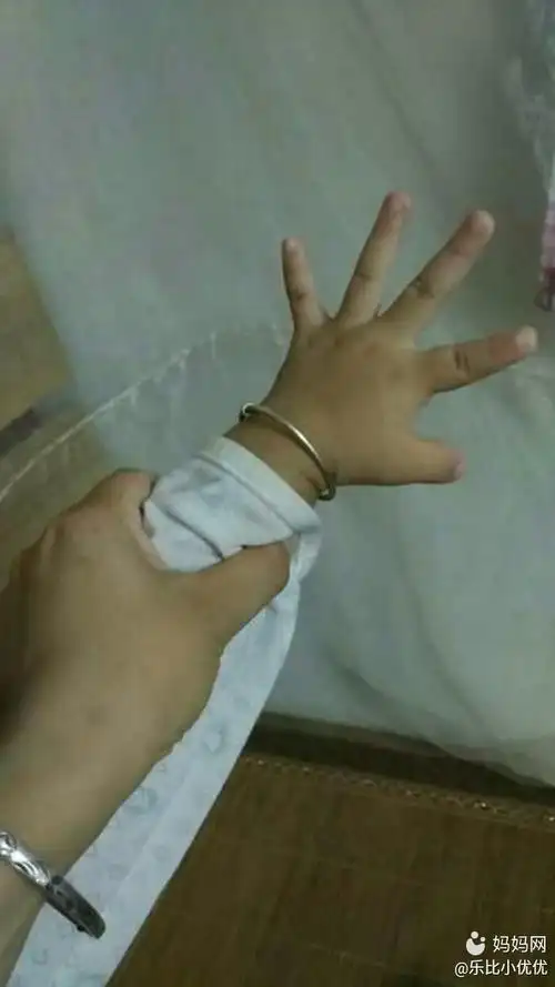 宝宝大拇指伸不直