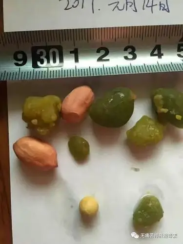 无痛苦排肝胆结石