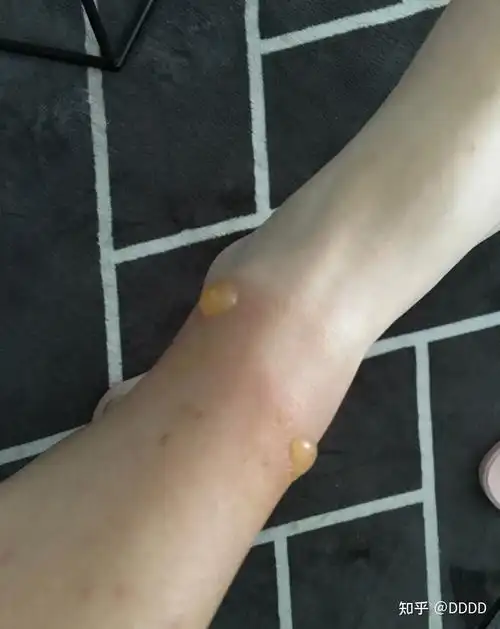 为什么被虫子咬的包会起水泡