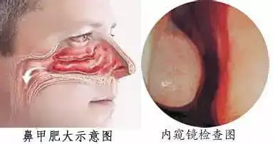 清鼻堂:鼻甲肥大的危害有哪些?