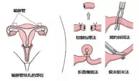 与女人结扎相比?到底哪个好
