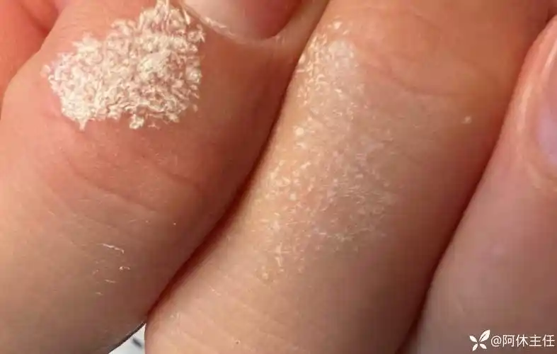 手指皮肤纯白色点状物