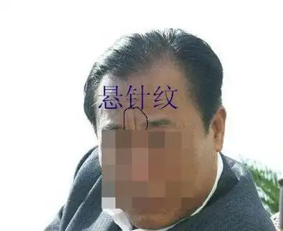 通天纹额头是什么样子图片,通天纹正黄旗什么意思?